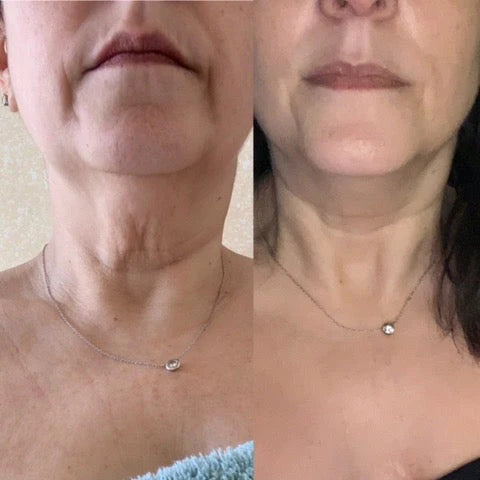 My Neck Finally Looks Smoother