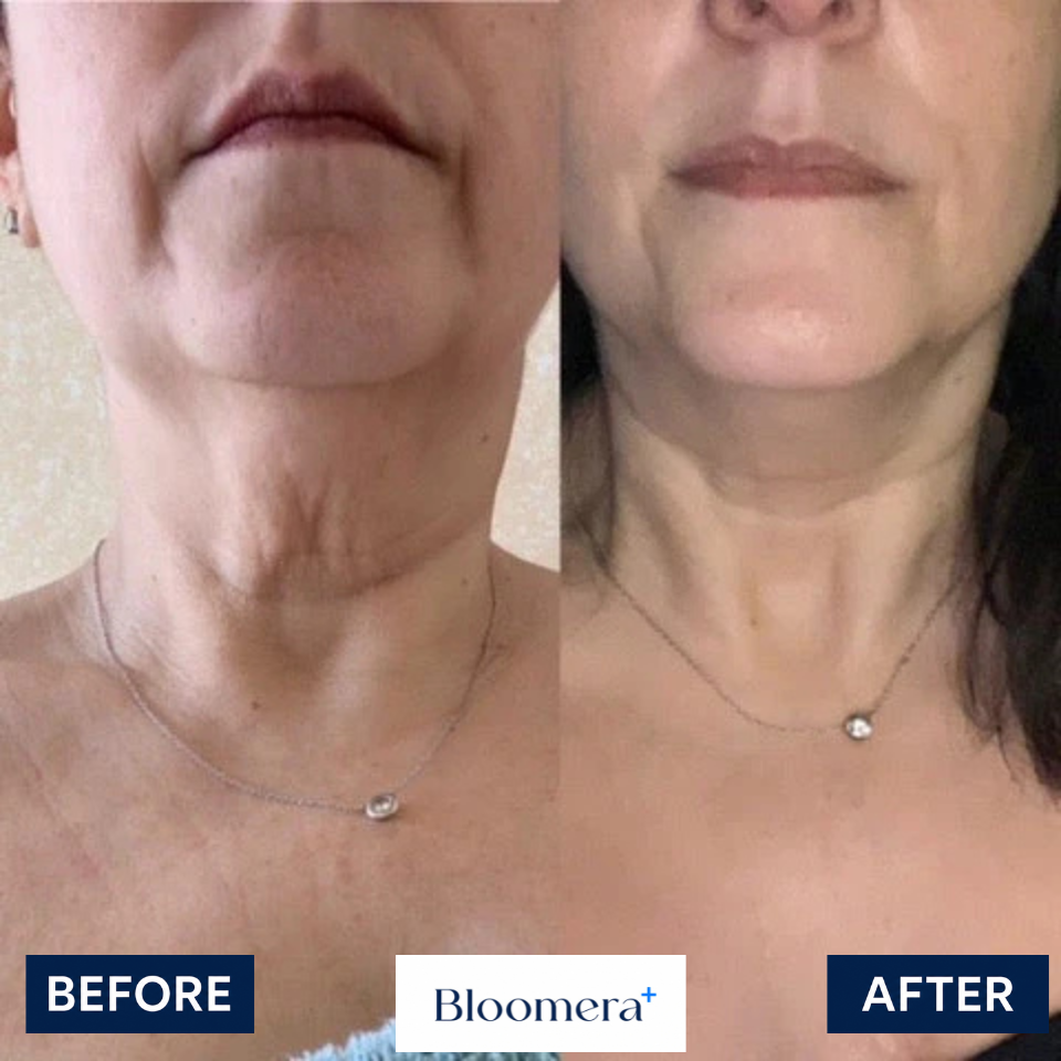 Bloomera NeckTighten Technology®