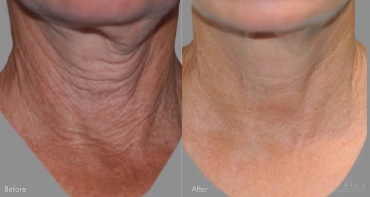 My Neck Finally Looks Smoother